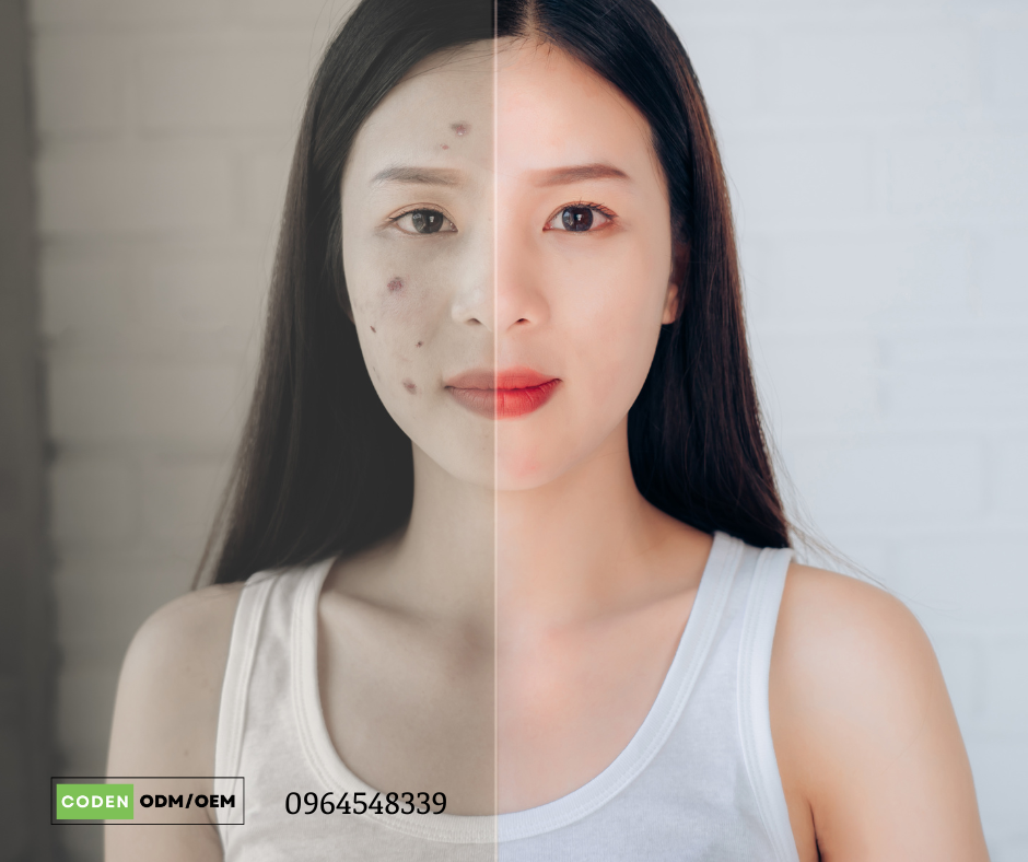 Cách chăm sóc da dầu mụn như thế nào?